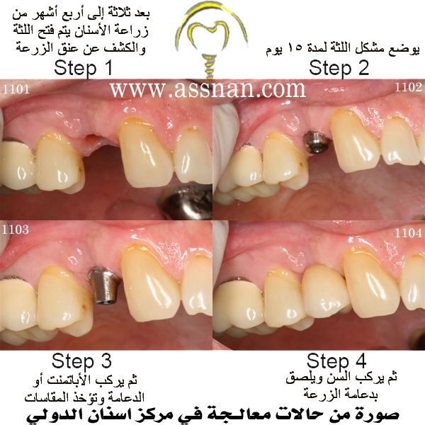 صورة لمراحل زراعة الأسنان - تركيب امشكل اللثة - تركيب الأباتمنت - تركيب تاج الزيركون 