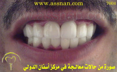 صورة لتركبات الأسنان الزيركونية بعد تعديل البروز 