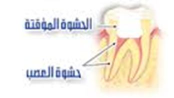 الحشوات المؤقته للأسنان