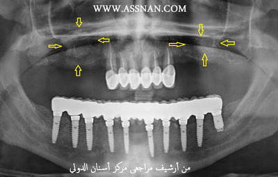 لثة المراجع قبل أن يتم ثقبها وغرس الزرعة ، زراعة عظم في الفك العلوي لاحظ الأسهم 