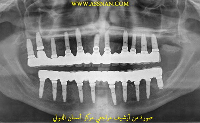 زراعة الفك العلوي وتحميل مباشر خلال 10 أيام 