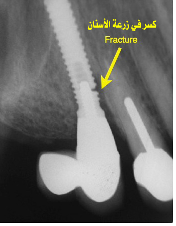 kiser-implant1