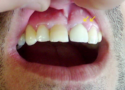 التهاب لثة بسيط محيط بتاج السيراميك