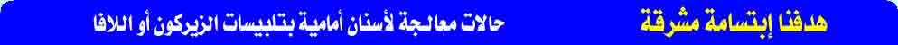 حالات معالجة بتلبيس أو تركيب الأسنان الأمامية 