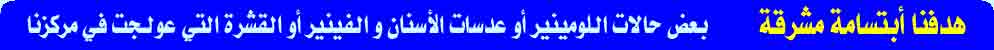 بعض حالات اللومينير أو عدسات الأسنان والفينير أو القشرة التي عولجت في مركزنا 