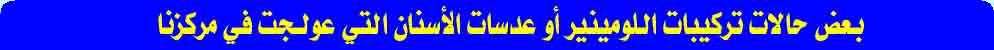 بعض حالات تركيبات اللومينير أو عدسات الأسنان التي عولجت في مركزنا