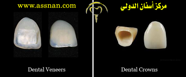 الفرق بين تركيبات الفينير وتركيبات الزيركون