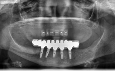 صورة شعاعية لزرعات الخمس في الفك السفلي 