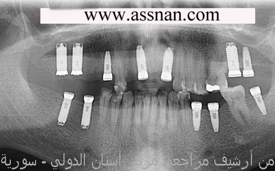 صورة لزرعات الأسنان التي زرعناها في كلا الفكين