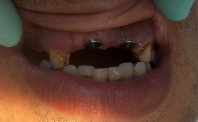 الزرعات وأسنان المراجع وقد أصاب الكثير من الأسنان التسوس