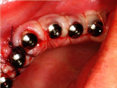 زرعات أسنان مضادة للتهابات اللثة والتي تحتوي زيركون ثورة جديدة عالم الأسنان zira3a-tbrimplant10.