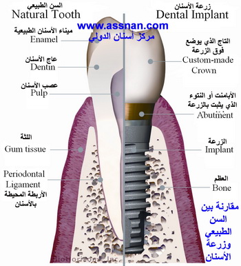 مقارنة بين زرعات الأسنان والأسنان الطبيعية 