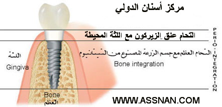 صورة تفصلية لخواص زرعة الأسنان ذات العنق الزيركوني tbr