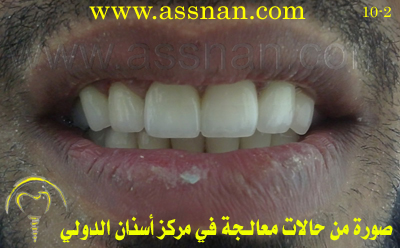 صورة لأسنان مراجع يعاني من تباعد الأسنان بعد العلاج