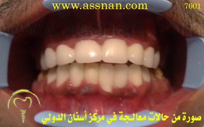 صورة لأسنان مراجع ركب تلبيسات زيركون بارزة في أحد العيادات في الرياض 