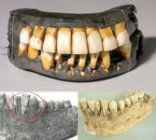 محاولة الأنسان في العصور الماضية لتركيب بدلات أو زراعة أسنان بديلة لأسنانه