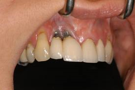 لا يمكن أن نوصل الأسنان الطبيعية مع الزرعات والنتيجة ستكون كما ترون تراجع اللثة وأنكشاف الزرعات 