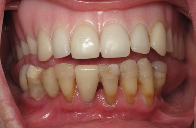 أسنان الفك السفلي قبل القلع لاحظ كيف تم ربطها مع بعض بمادة الكمبوزيت حتى لا تهتز