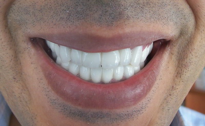   الأبتسامة الهوليودية التي حصل عليها بعد تركيب تركيبات الزيركون فوق الزرعات وفوق الأسنان المتبقية