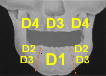 تقسم قساوة العظم إلى أربع درجات حسب مناطق توضع العظم في الفكين ال الدرجة D1 أكثر قساوة وهكذا